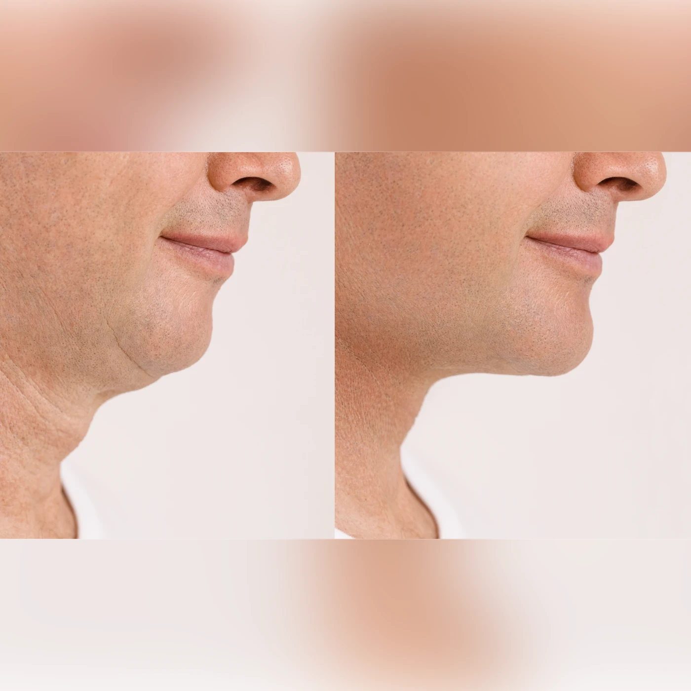 before and after photo of male facial liposuction copy