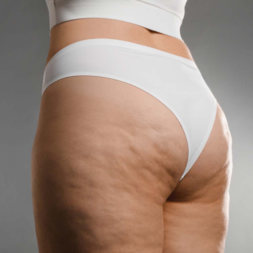 cellulite on womans buttox