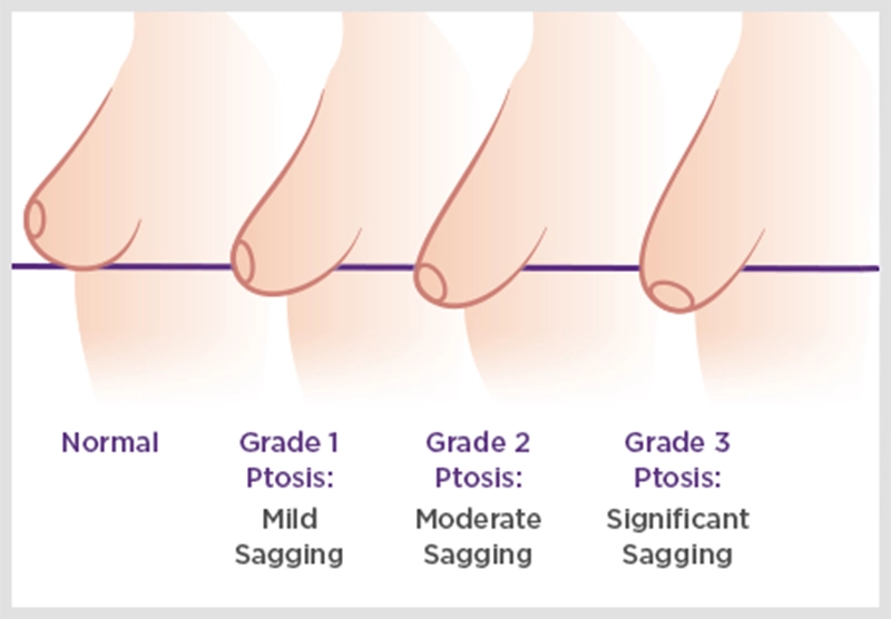 breast ptosis diagram