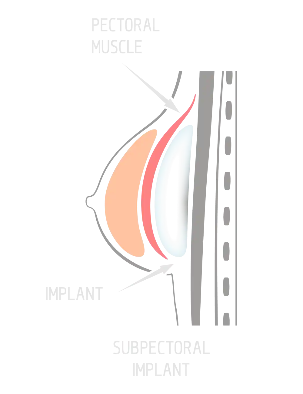 submuscular breast implant placement graphic